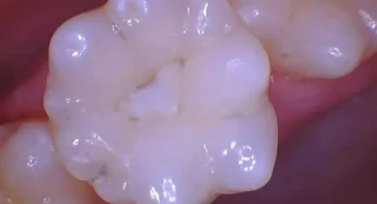 Kenali Mulberry Teeth: Bentuk Gigi Seperti Buah Murbei