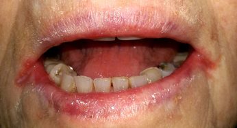 Angular Cheilitis: Luka di Sudut Bibir yang Sering Diremehkan