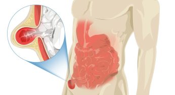 Hernia Inguinalis: Ketika Usus Menonjol ke Area Selangkangan