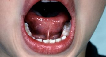 Frenulum Lingualis Tinggi, Dampaknya pada Kemampuan Bicara