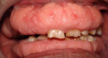 Fibromatosis Gingiva: Tumor Jinak pada Gusi