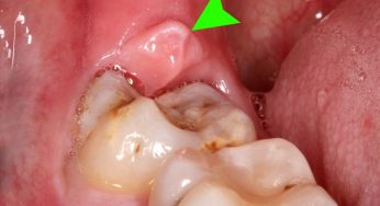 Perikoronitis: Radang Gusi Sekitar Gigi Bungsu yang Terabaikan