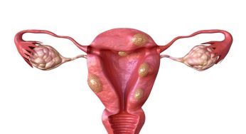 Mioma Uteri: Tumor Jinak yang Sering Menyerang Rahim Wanita