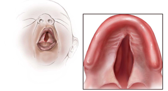 Kelainan Bawaan “Cleft Palate”: Celah Langit-Langit Mulut
