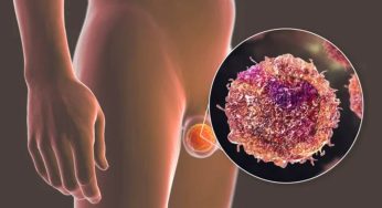 Kanker Testis pada Organ Reproduksi Pria, Kenali Gejalanya!