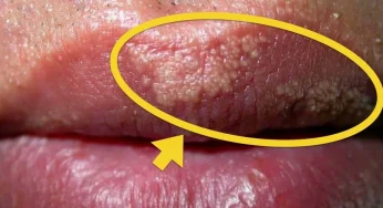 Fordyce Spots: Bintik Kecil yang Sering Disalahpahami