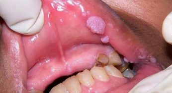 Papilloma Oral: Infeksi Virus Papilloma di Rongga Mulut
