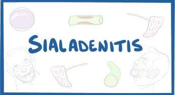 Sialadenitis: Ketika Kelenjar Ludah Mengalami Peradangan