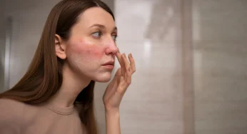 Jangan Abaikan! 10 Tanda Penyakit Lupus yang Terlihat Sepele