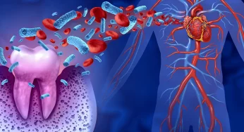 Kaitan Periodontitis dan Jantung: Ancaman dari Mulut ke Jantung