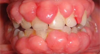Efek Samping Obat Fenitoin: Waspadai Pembesaran Gingiva
