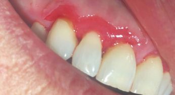 Desquamative Gingivitis: Penyakit Gusi Langka yang Menyakitkan