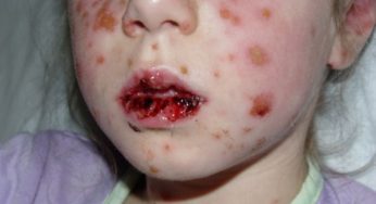 Stevens-Johnson Syndrome: Kondisi Langka dengan Risiko Fatal