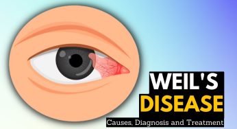 Bahaya Weil’s Disease, Infeksi Berat Akibat Leptospirosis