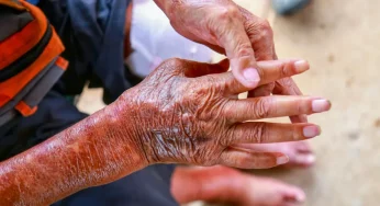 Skleroderma: Penyakit Autoimun yang Pengaruhi Kulit dan Organ