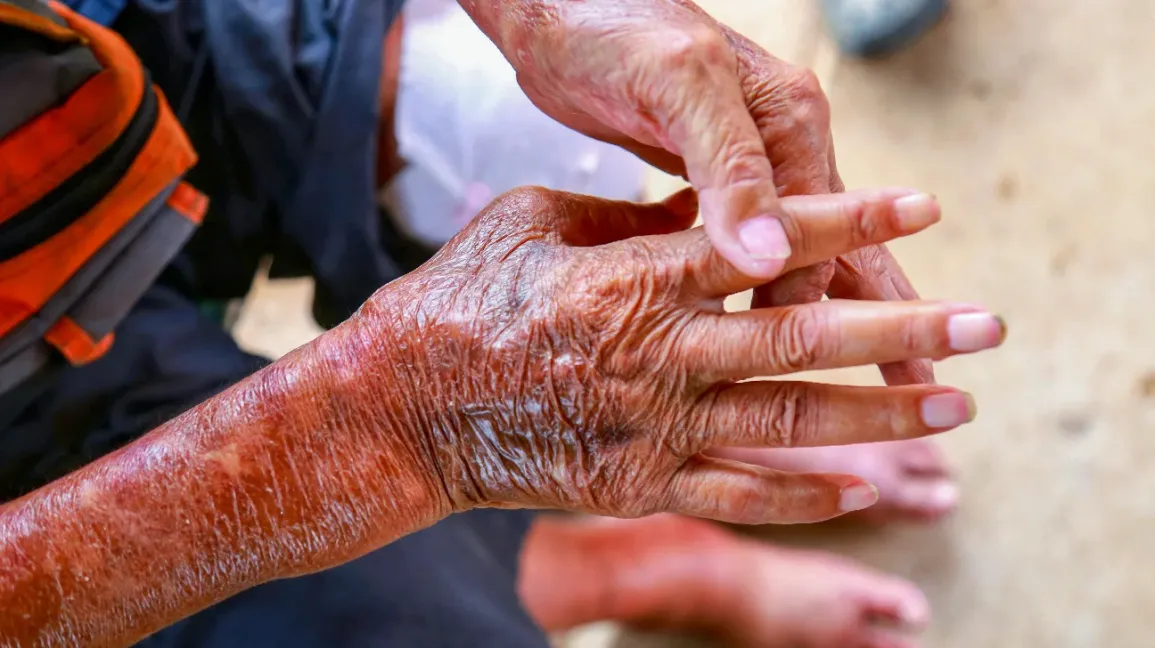 penyakit autoimun skleroderma