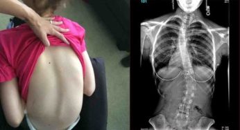 Mitos atau Fakta: Membawa Tas Berat di Satu Sisi Bisa Sebabkan Skoliosis?
